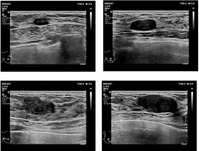 Case report: Fibroadenomas associated with atypical ductal hyperplasia and infiltrating epitheliosis mimicking invasive carcinoma